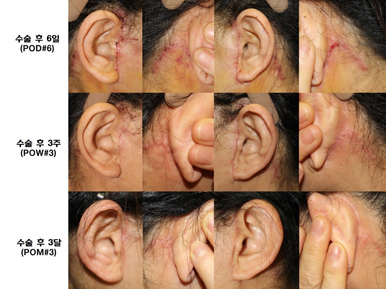 55세 여성, 이중평면 안면거상(55/F, Dual-plane full facelift) 관련 이미지 66