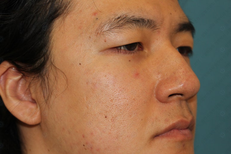 27세 남성 무쌍(속쌍)눈매교정 (27/M Ptosis correction with double lid plasty) 관련 이미지 11