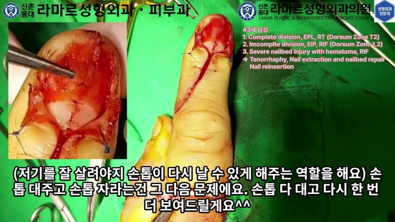 손가락 힘줄 손상 및 열상, 손톱 바닥 열상 처치 (Extensor tendon repair and nailbed injury treatment) 관련 이미지 28