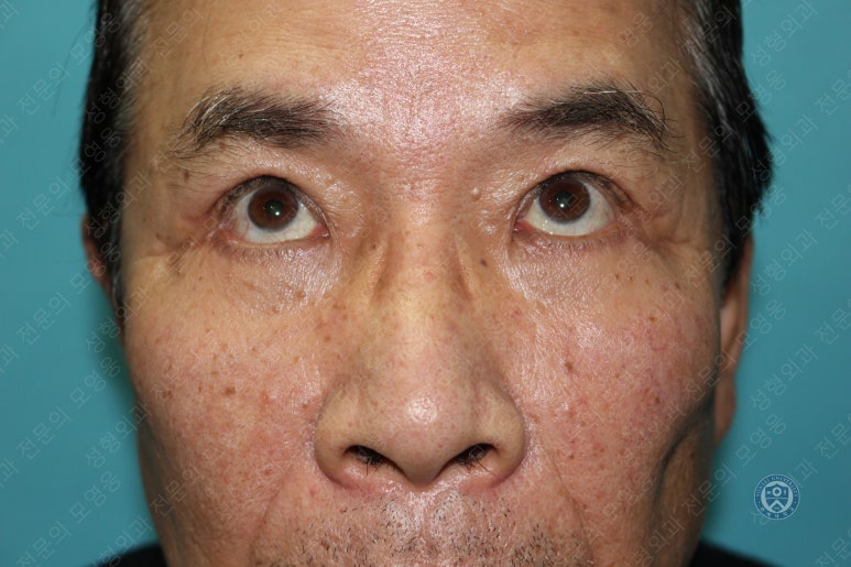 67세 남성, 상&middot;하안검성형술 및 안검하수교정 (67/M, Upper &  lower blepharoplasty with ptosis correction) 관련 이미지 39