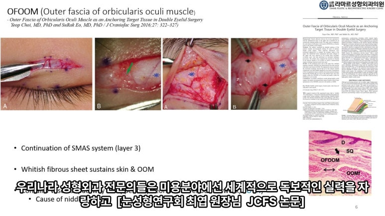 이대역 성형외과 개원의 퇴근 후 V-log 제 8편 : 눈성형연구회 학술심포지엄 발표 (눈성형연구회 학술위원) 관련 이미지 58