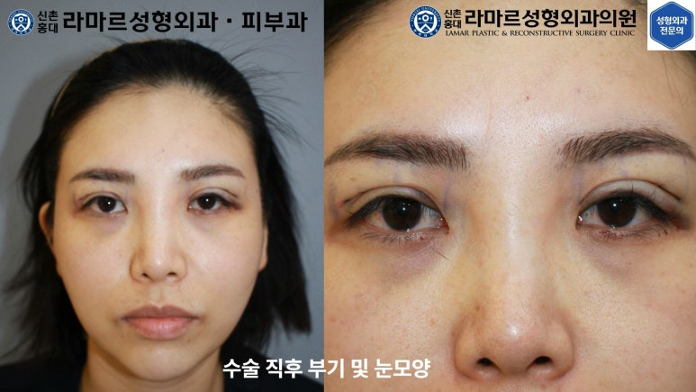 30대 여성 "쌍꺼풀+눈매교정" 상담, 디자인, 수술 전체 과정, 결과, 경과 모두 공개합니다. 관련 이미지 42