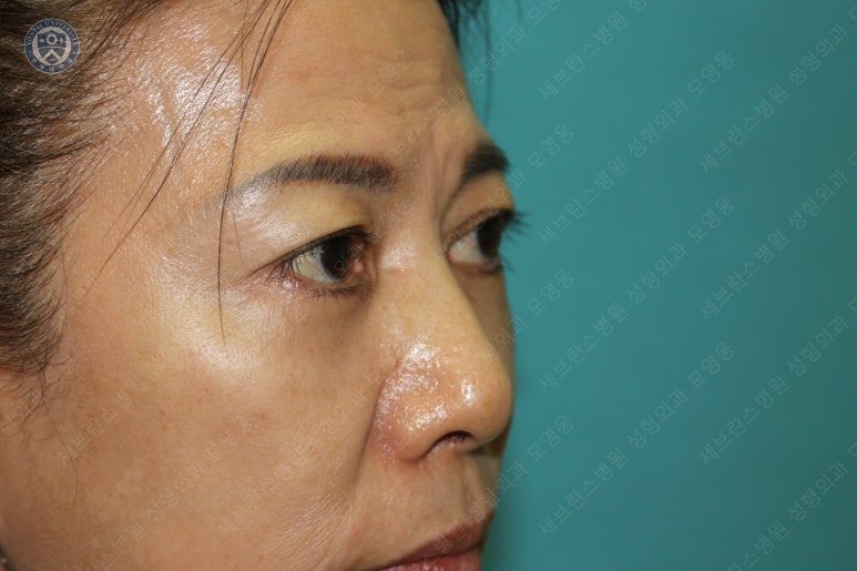 59세 여성, 그레이브스 안병증이 있는 돌출눈 중년 여성 하안검 성형술 (Lower blepharoplasty in Graves 관련 이미지 39