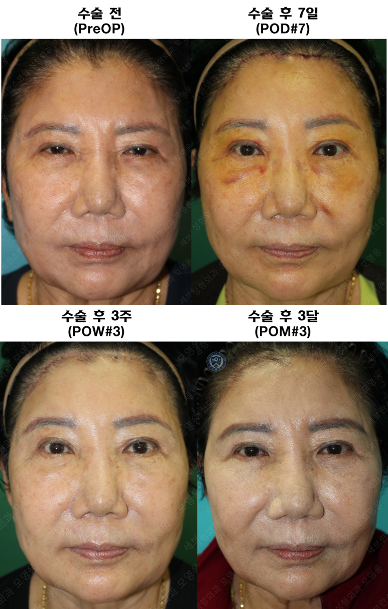 71세 여성, 이마거상술과 이마축소술 (71/F, Forehead lift and reduction) 관련 이미지 54