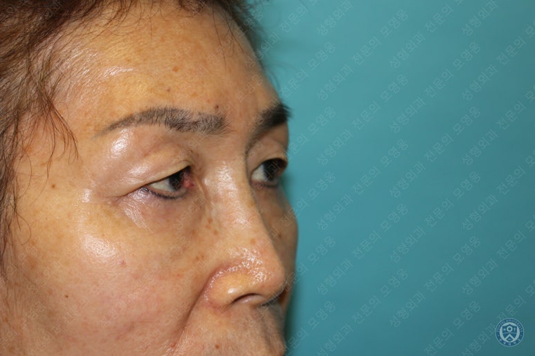 64세 여성 상안검성형술+눈매교정 (64/F Upper blepharoplasty with ptosis correction) 관련 이미지 8