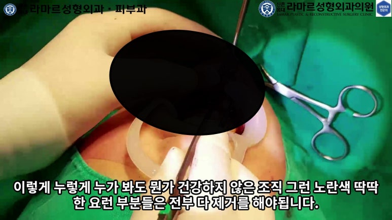 파라핀 필러 입 안 절개로 흉터없이 빼내기! 관련 이미지 74
