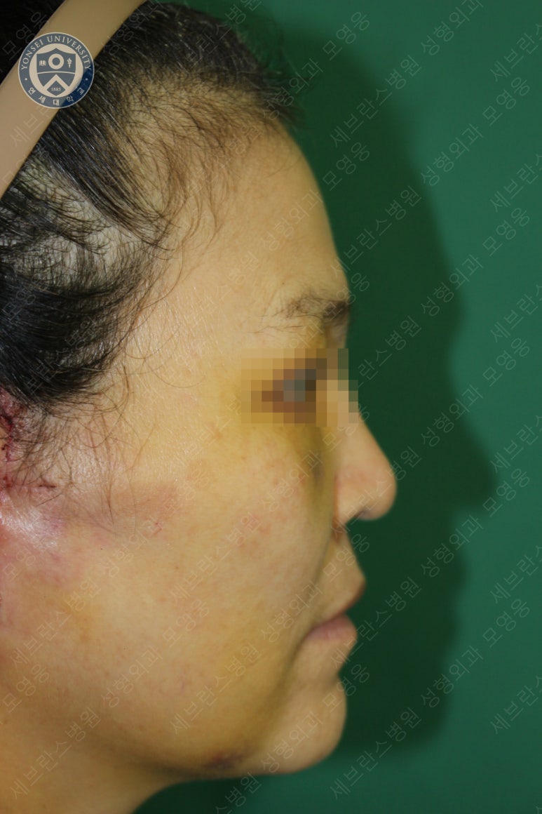 55세 여성, 이중평면 안면거상(55/F, Dual-plane full facelift) 관련 이미지 21