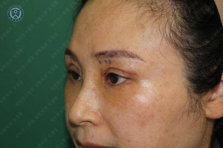 49세 여성, 토안이 있는 중년여성의 상안검성형술 (49/F, Upper blepharoplasty with lagophthalmos correction& LP) 관련 이미지 21