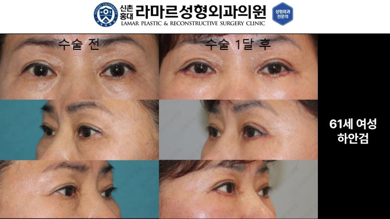 30대~80대 눈 수술 케이스 : 하안검성형술 전후 사진 모음 관련 이미지 13