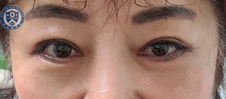 60세 여성, 상안검 및 하안검 성형술 증례 (60/F Upper & lower blepharoplasty) 관련 이미지 33