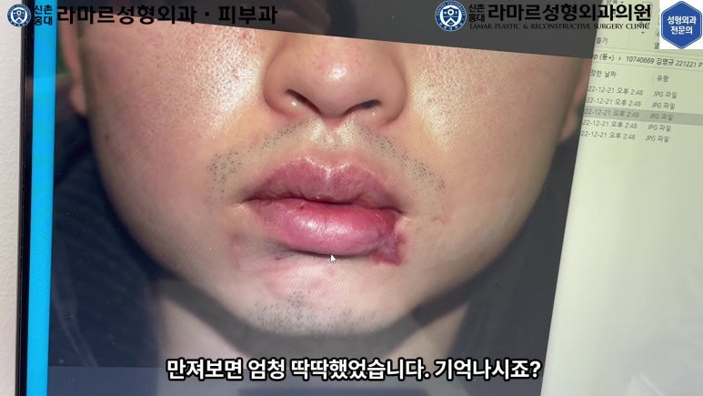 개에 물려 입술 1/3이 뜯긴 19세 남자분 치료 및 흉터 성형수술& 레이저 후기....! 관련 이미지 27