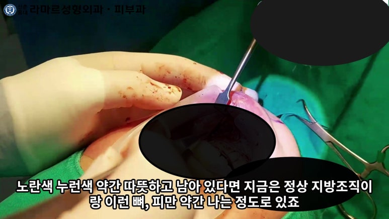 파라핀 필러 입 안 절개로 흉터없이 빼내기! 관련 이미지 66