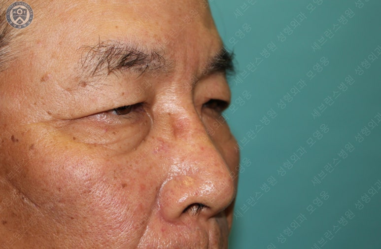 67세 남성, 상&middot;하안검성형술 및 안검하수교정 (67/M, Upper &  lower blepharoplasty with ptosis correction) 관련 이미지 14