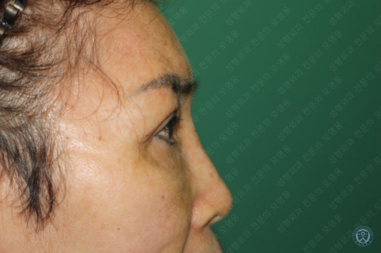 64세 여성 상안검성형술+눈매교정 (64/F Upper blepharoplasty with ptosis correction) 관련 이미지 17