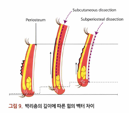 71세 여성, 이마거상술과 이마축소술 (71/F, Forehead lift and reduction) 관련 이미지 18