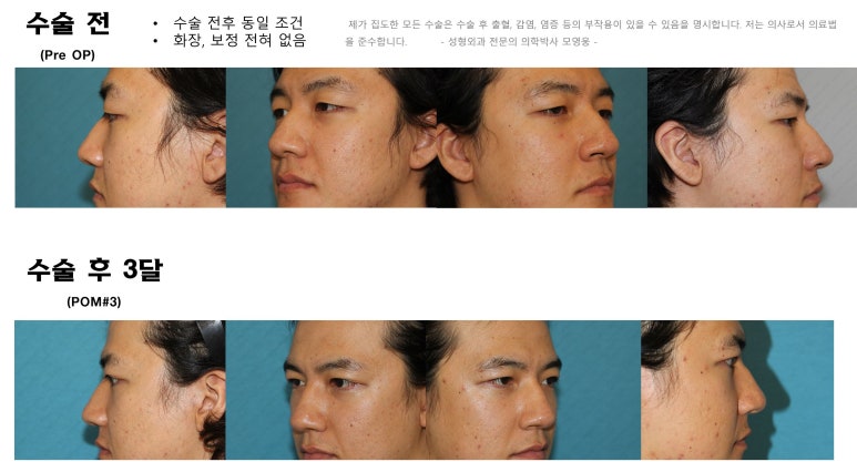 27세 남성 무쌍(속쌍)눈매교정 (27/M Ptosis correction with double lid plasty) 관련 이미지 41
