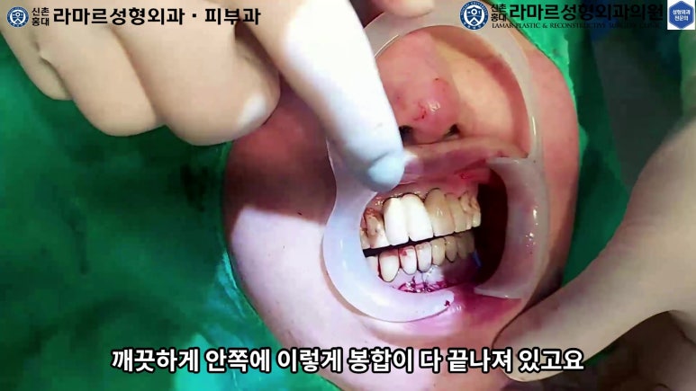 파라핀 필러 입 안 절개로 흉터없이 빼내기! 관련 이미지 82