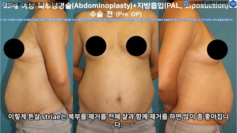 '복부성형술+지방흡입(Abdominoplasty+PAL)' 으로 뱃살 끝장내기! 관련 이미지 35
