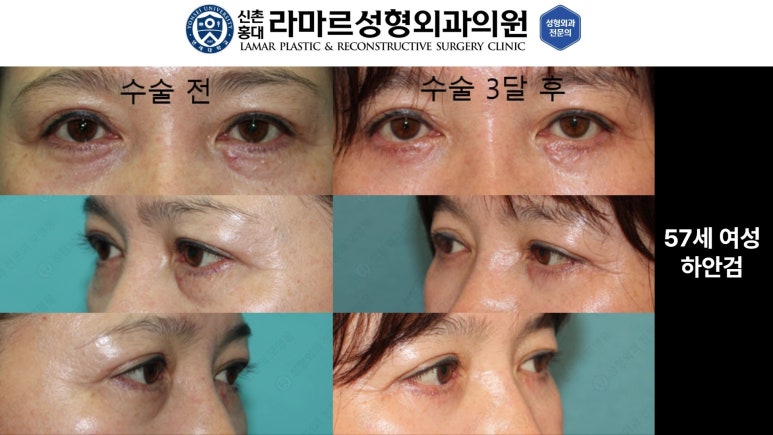 30대~80대 눈 수술 케이스 : 하안검성형술 전후 사진 모음 관련 이미지 51