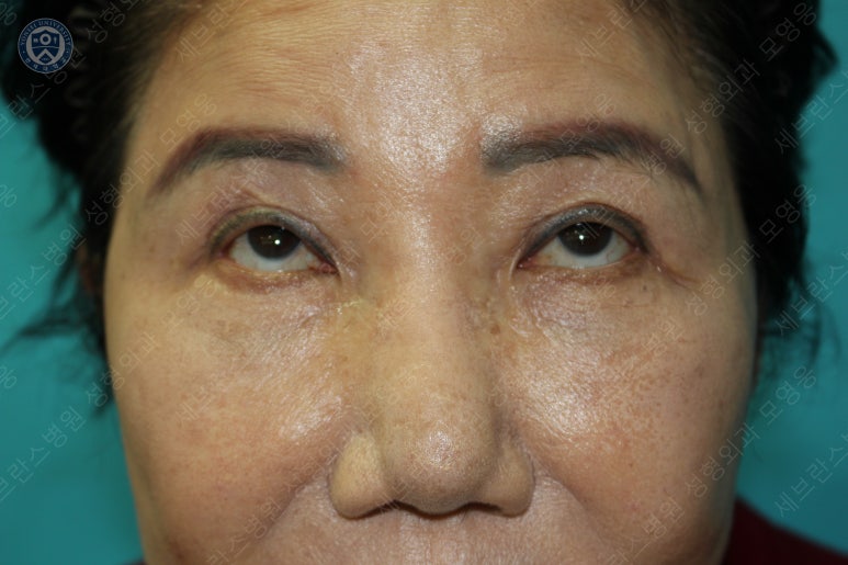 71세 여성, 이마거상술과 이마축소술 (71/F, Forehead lift and reduction) 관련 이미지 43