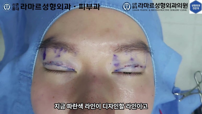 29세 남자, 소시지 쌍꺼풀 두줄따기로 낮추기 (쌍꺼풀 재수술) 관련 이미지 22