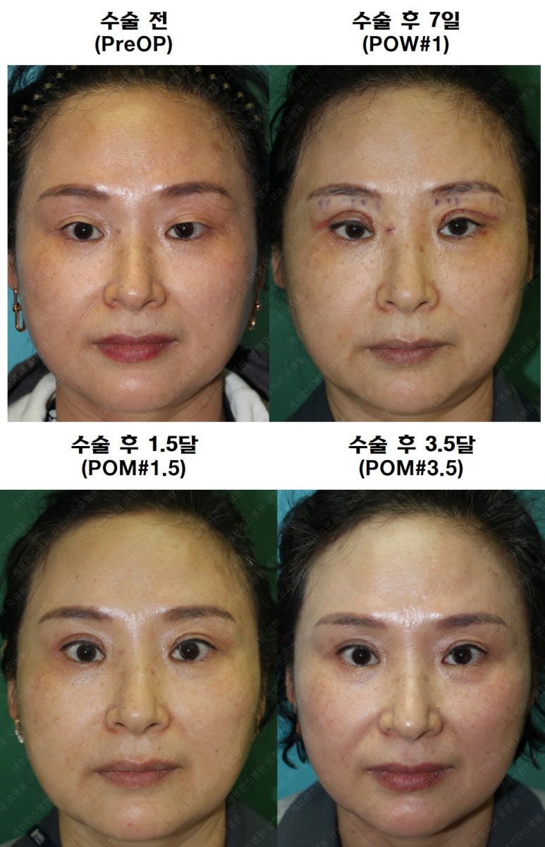 49세 여성, 토안이 있는 중년여성의 상안검성형술 (49/F, Upper blepharoplasty with lagophthalmos correction& LP) 관련 이미지 43