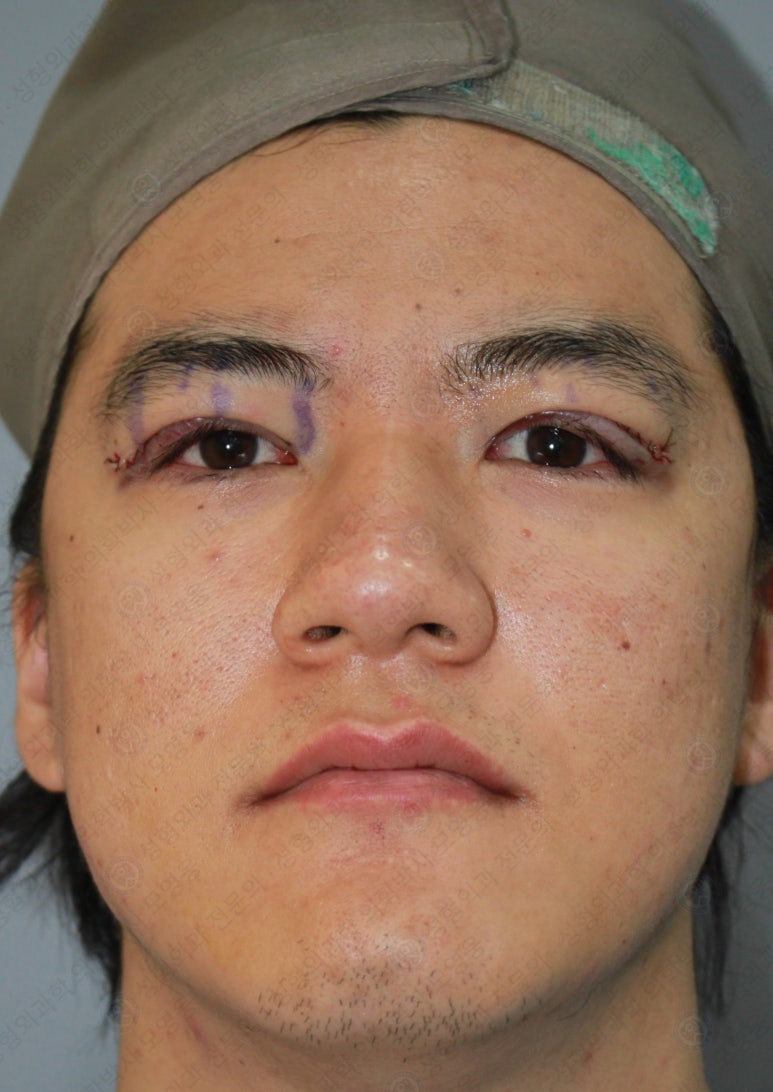 27세 남성 무쌍(속쌍)눈매교정 (27/M Ptosis correction with double lid plasty) 관련 이미지 13