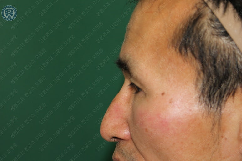 남자눈성형: 무쌍눈매교정 (Blephroptosis correction-levator aponeurosis advancement) 관련 이미지 42