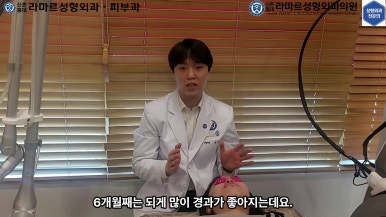 21세 여성 코 지름 1cm 점 제거수술 : 나선피판술(Spiral Flap) 수술전~5달 경과. (+쌍꺼풀수술, 코필러) 관련 이미지 53