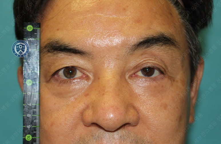 68세 남성, 하안검 성형술 및 안검외반 교정 증례(68/M Lower blepharoplasty & Ectropion correction with triamcinolone) 관련 이미지 19
