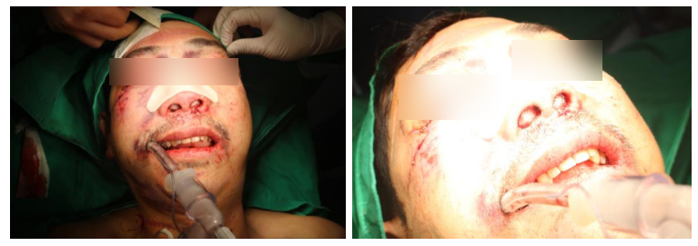 57세 남성, 얼굴 전체골절(57/M Panfacial bone fracture) 수술 및 흉터관리 증례 관련 이미지 13