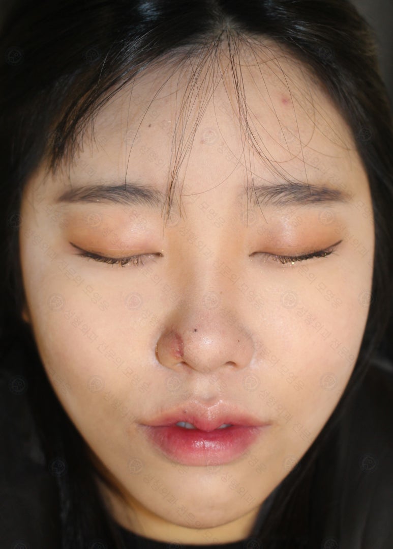 지름 1cm 코 점 제거수술 : 나선피판술(Spiral Flap) 수술전~1달 경과. (Feat. 턱끝필러+사각턱 보톡스) 관련 이미지 184
