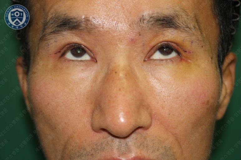 남자눈성형: 무쌍눈매교정 (Blephroptosis correction-levator aponeurosis advancement) 관련 이미지 23