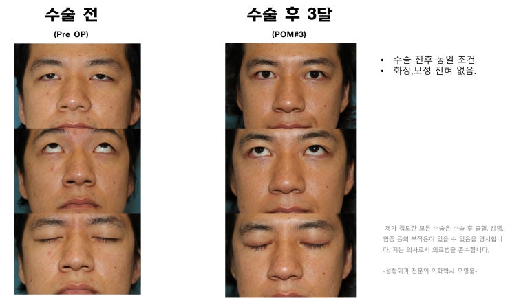 27세 남성 무쌍(속쌍)눈매교정 (27/M Ptosis correction with double lid plasty) 관련 이미지 40