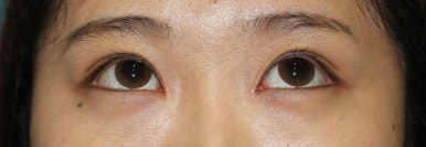 17세 여성, 쌍꺼풀+앞트임(DEO+Medial epicanthoplasty) 관련 이미지 24