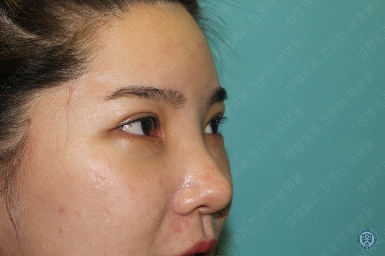28세 여성 두줄따기, 눈밑지(28/F D.E.O & transconjunctival septal fat redraping) 관련 이미지 16
