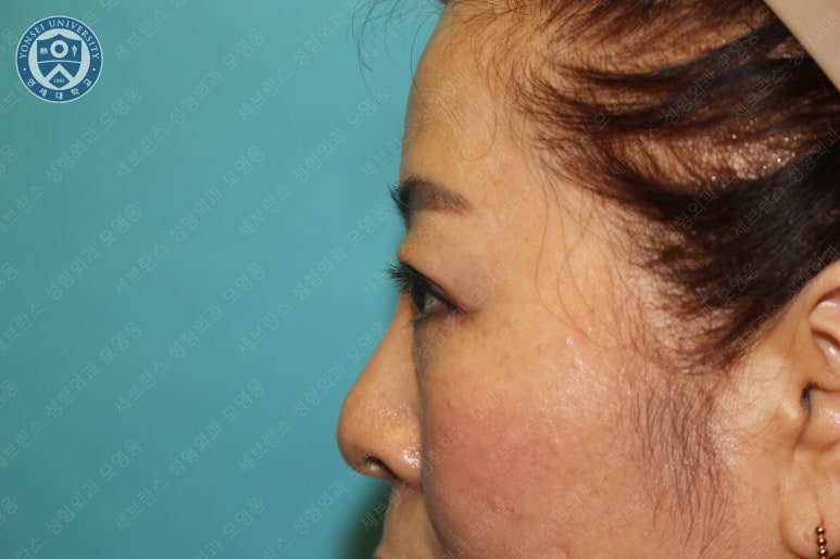 60세 여성, 상안검 및 하안검 성형술 증례 (60/F Upper & lower blepharoplasty) 관련 이미지 26