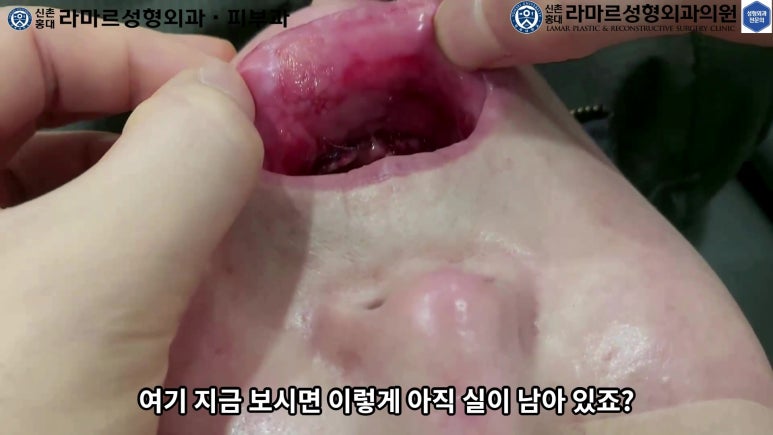 파라핀 필러 입 안 절개로 흉터없이 빼내기! 관련 이미지 108