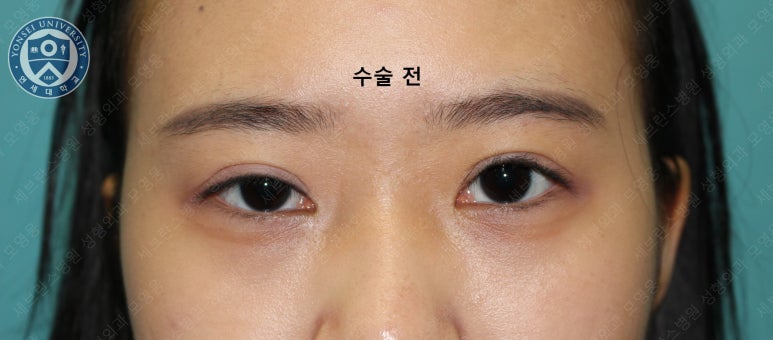 17세 여성, 비절개 눈매교정 및 앞트임 재수술 (17/F NI ptosis correction & Med. epicanthoplasty revision) 증례 관련 이미지 2