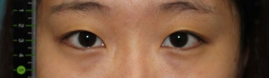 17세 여성, 쌍꺼풀+앞트임(DEO+Medial epicanthoplasty) 관련 이미지 12