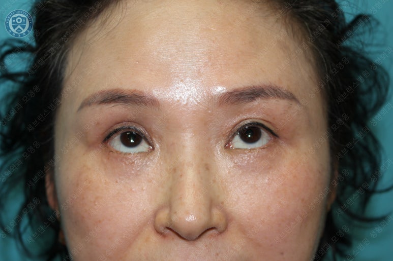 49세 여성, 토안이 있는 중년여성의 상안검성형술 (49/F, Upper blepharoplasty with lagophthalmos correction& LP) 관련 이미지 35
