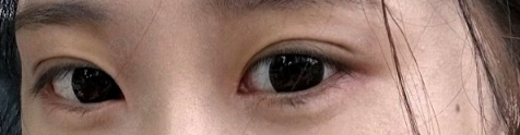 17세 여성, 쌍꺼풀+앞트임(DEO+Medial epicanthoplasty) 관련 이미지 42