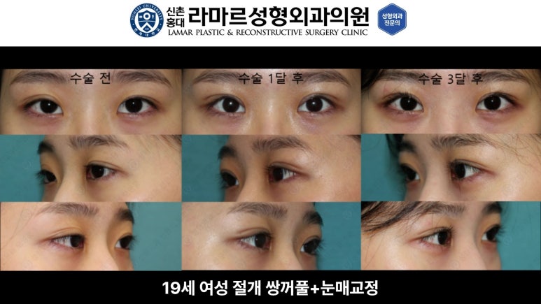 10대~30대 눈 수술 케이스 : 대표원장님 쌍꺼풀 전후 사진 모음 관련 이미지 13