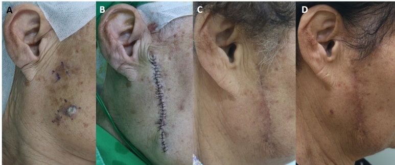 Medicine - Comparison of the recurrence rate of 3 treatmentmodalities for BD in an aging city 관련 이미지 9