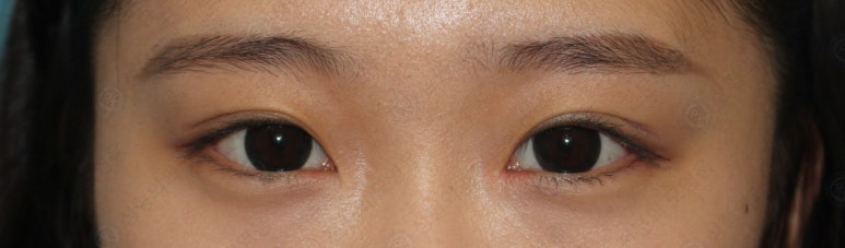 17세 여성, 쌍꺼풀+앞트임(DEO+Medial epicanthoplasty) 관련 이미지 43