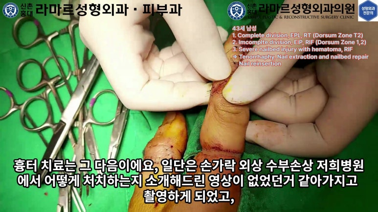 손가락 힘줄 손상 및 열상, 손톱 바닥 열상 처치 (Extensor tendon repair and nailbed injury treatment) 관련 이미지 35