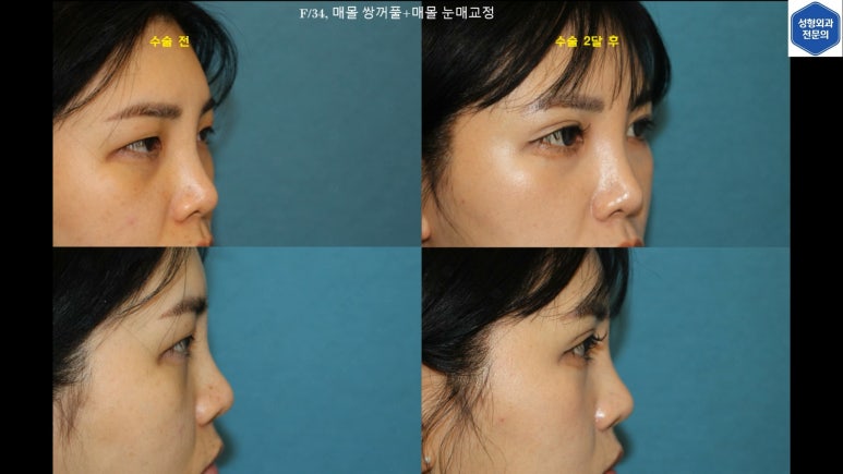 30대 여성 "쌍꺼풀+눈매교정" 상담, 디자인, 수술 전체 과정, 결과, 경과 모두 공개합니다. 관련 이미지 93