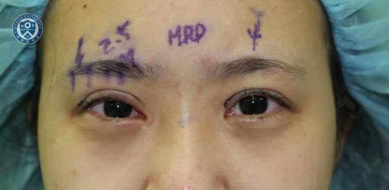 17세 여성, 비절개 눈매교정 및 앞트임 재수술 (17/F NI ptosis correction & Med. epicanthoplasty revision) 증례 관련 이미지 10