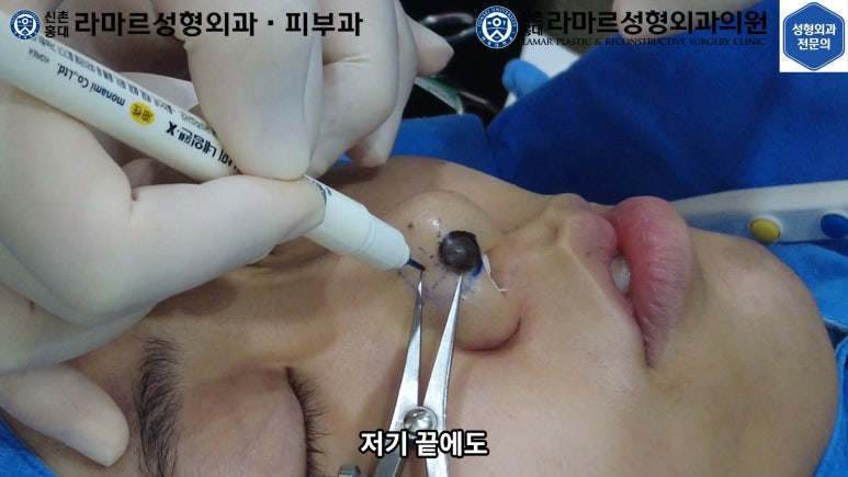 지름 1cm 코 점 제거수술 : 나선피판술(Spiral Flap) 수술전~1달 경과. (Feat. 턱끝필러+사각턱 보톡스) 관련 이미지 60