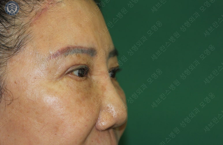 71세 여성, 이마거상술과 이마축소술 (71/F, Forehead lift and reduction) 관련 이미지 35